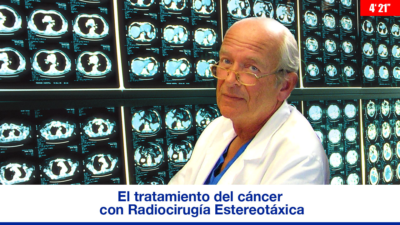 El tratamiento del cáncer con Radiocirugía Estereotáxica